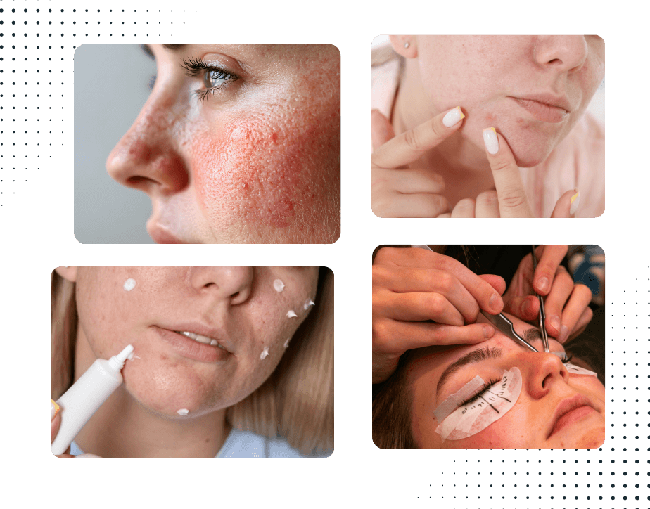 Best Acne Treatment in Gurgaon