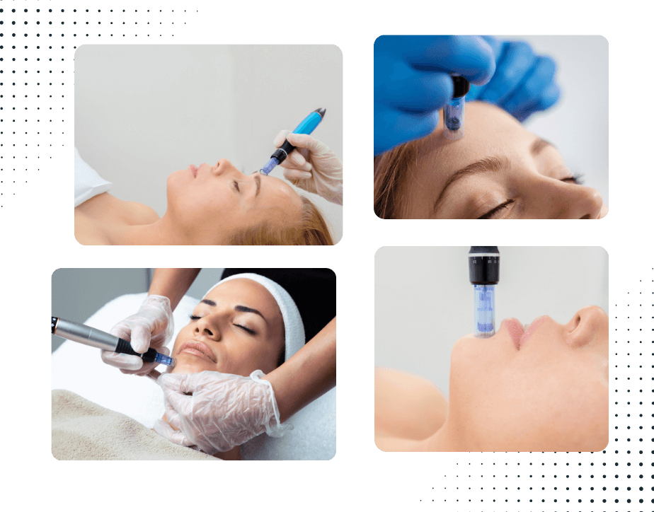 microneedling treatment