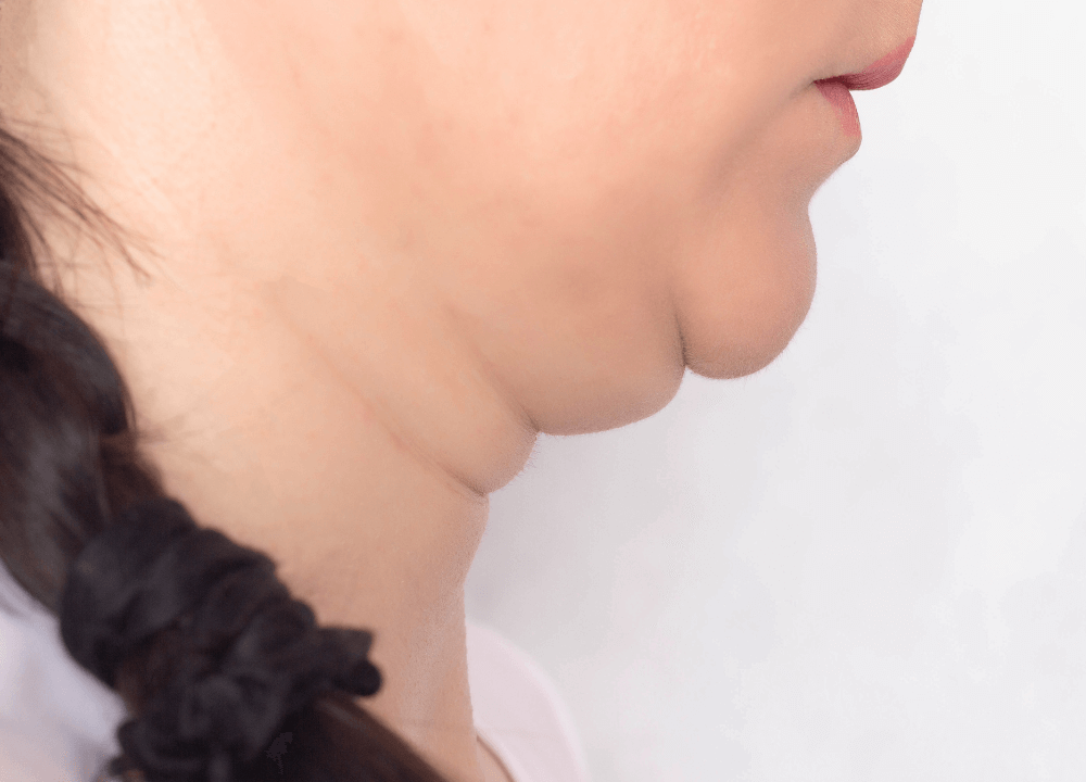 Double Chin Reduction Treatment in Gurgaon