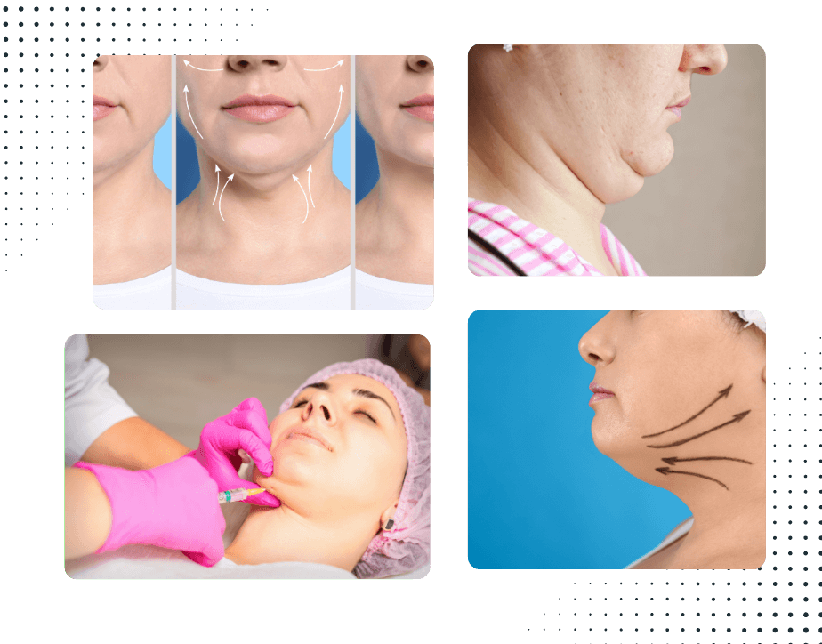 Double Chin Reduction