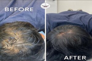 Read more about the article Hair Fall: Causes, Prevention, and Treatment