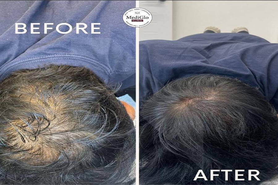 Read more about the article Hair Fall: Causes, Prevention, and Treatment