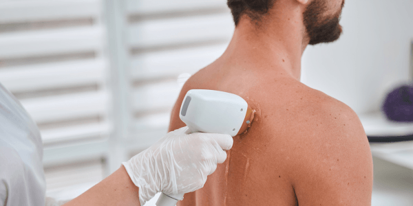 Back Laser Hair Reduction