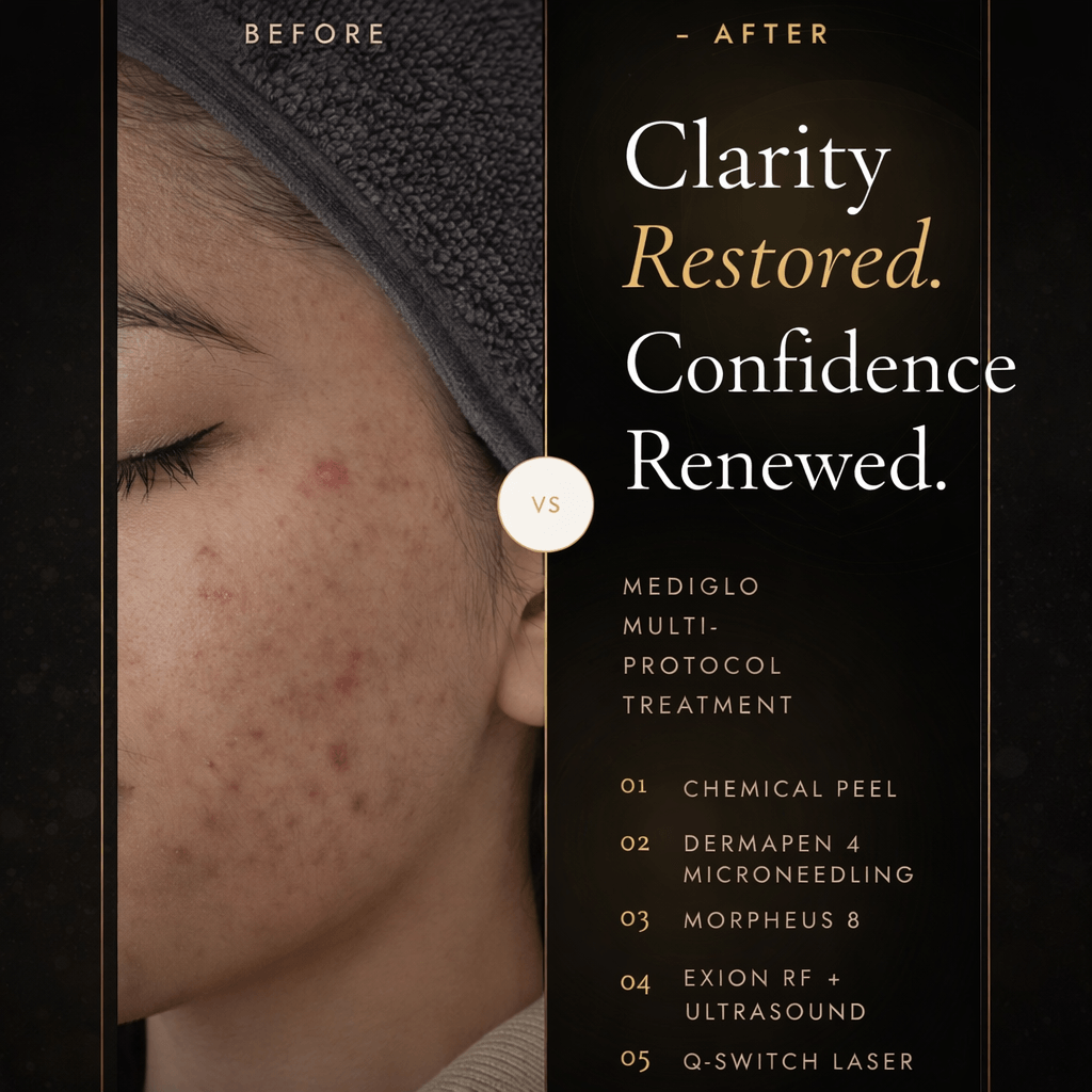 Acne Treatment
