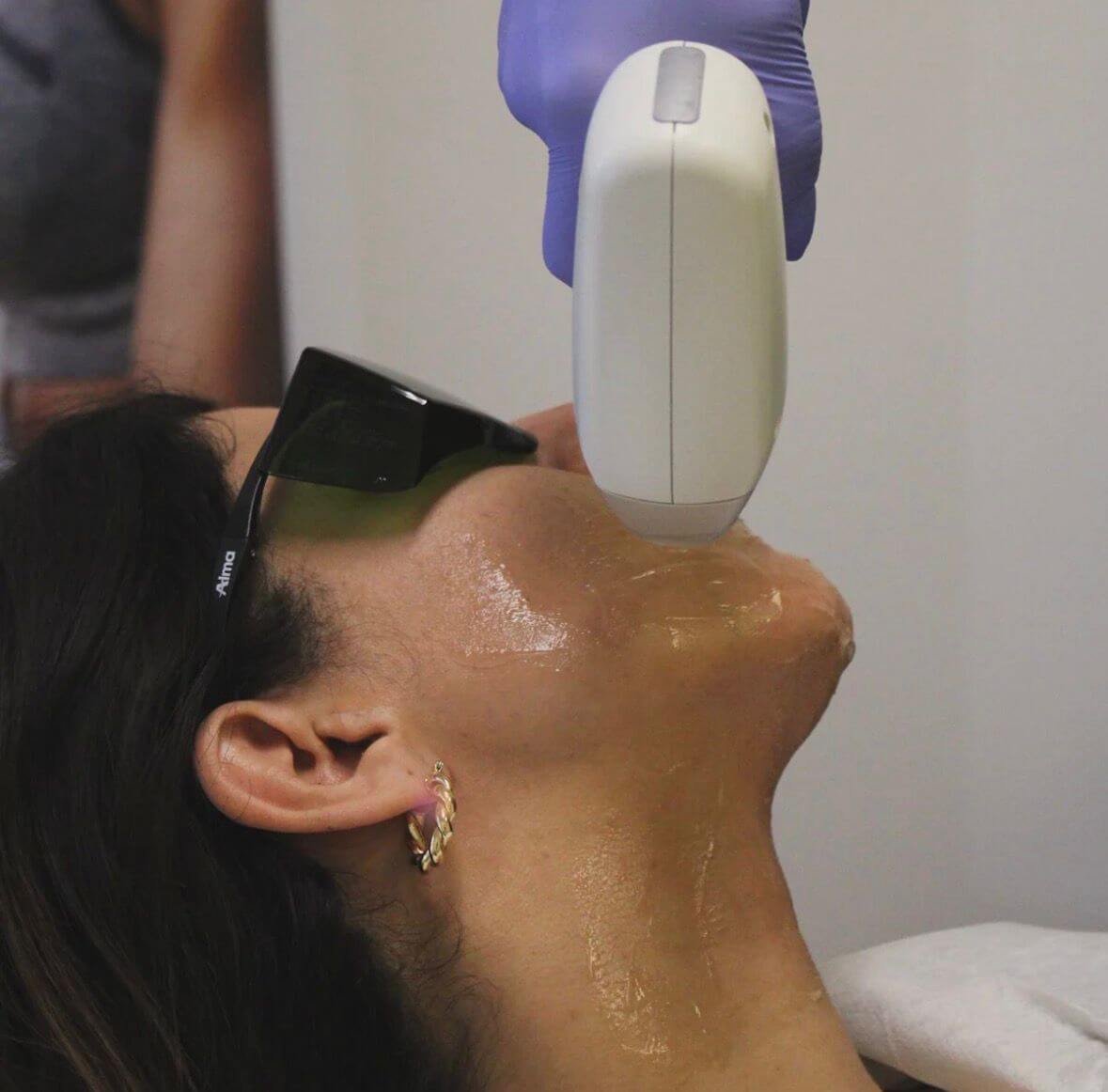 Chin Laser Hair Removal