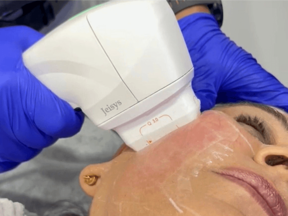 HIFU Treatment in Gurgaon