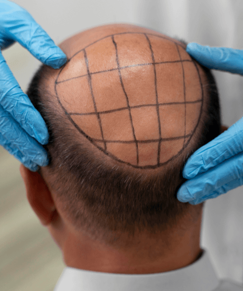 Hair Transplant in Gurgaon