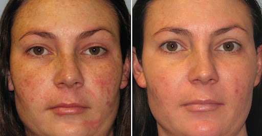 Read more about the article Easy Skin Care Tips to Reduce Pigmentation