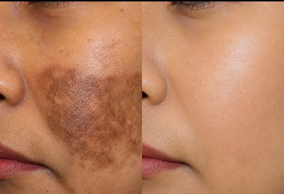 Pigmentation Treatment Protocol