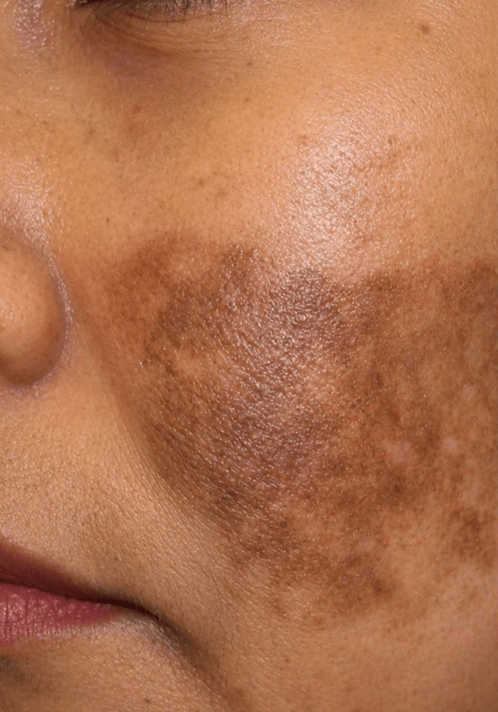 Untreated Pigmentation
